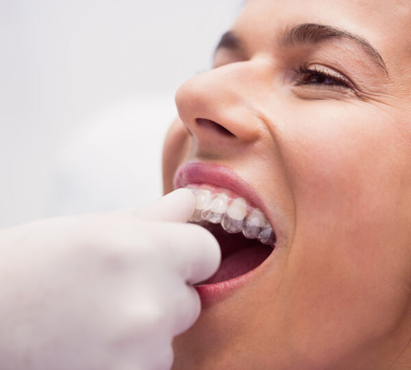 Best Invisalign Treatment in Hyderabad